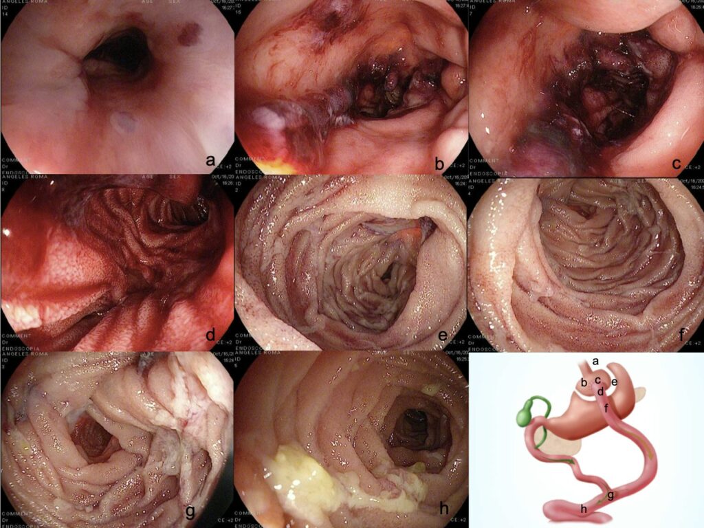 Intraoperative Endoscopic Landmarks Of Roux-En-Y Lgbp By Andrés Rodríguez Parra