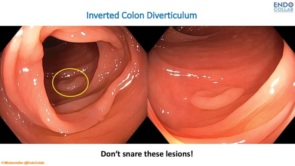Inverted Colon Diverticulum 13 Inverted Colon Diverticulum
