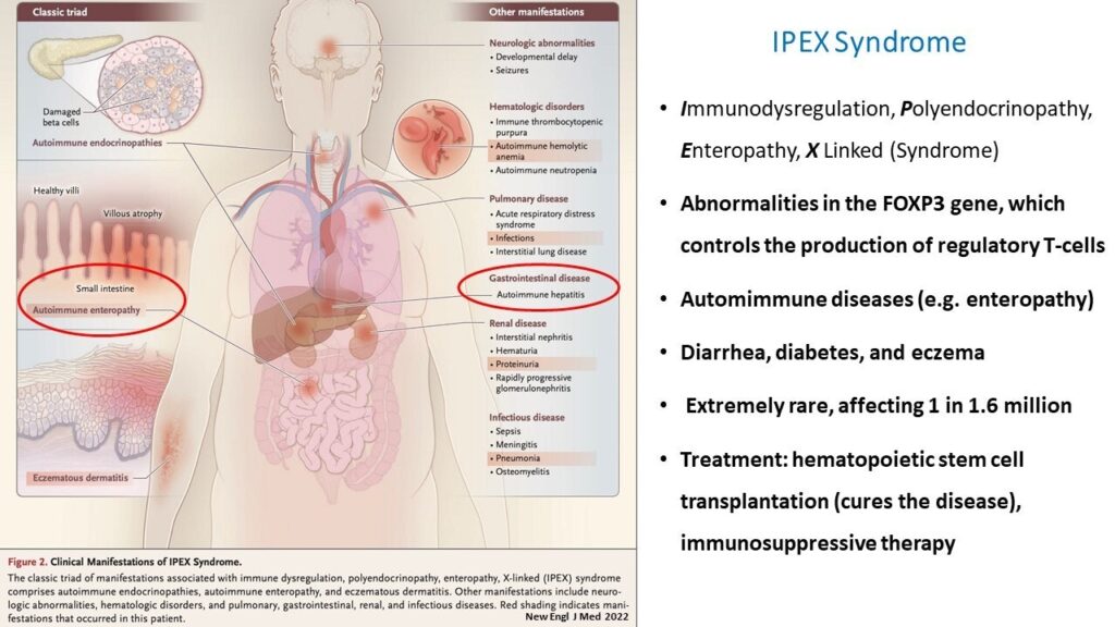 Ipex Syndrome 13 Ipex Syndrome
