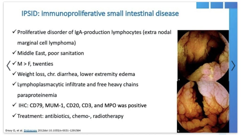 Ipsid (Immunoproliferative Small Intestinal Disease)