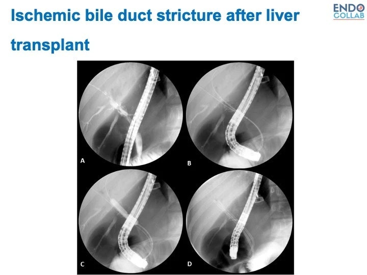 Ischemic Bile Duct Stenosis