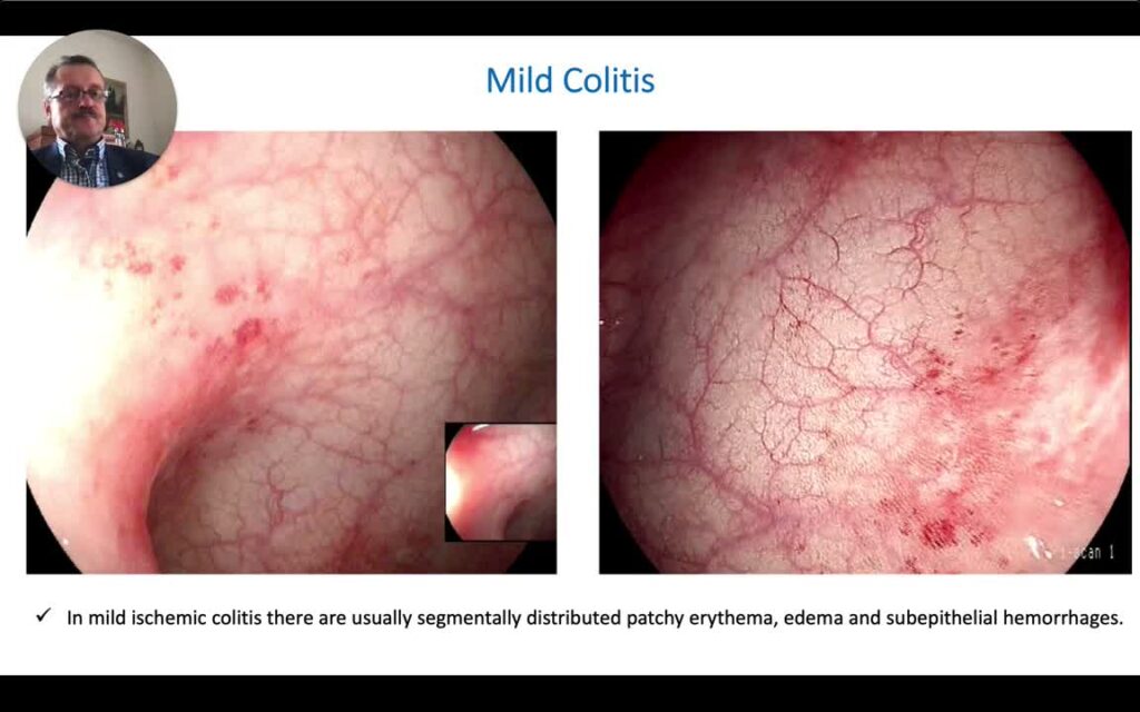 Ischemic Colitis - Endoscopic Spectrum 12 Ischemic Colitis – Endoscopic Spectrum