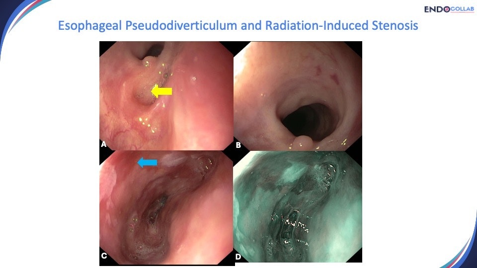 It Nano Knife For Resection Of An Esophageal Pseudodiverticulum 7 It Nano Knife For Resection Of An Esophageal Pseudodiverticulum