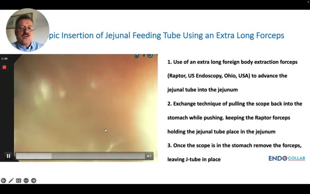 Jejunal Feeding Tube Raptor Technique