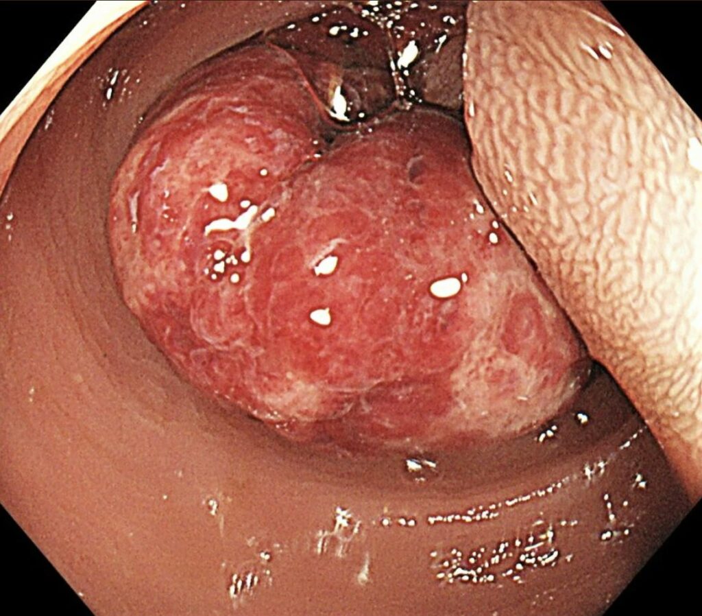 Juvenile Colon Polyp 8 Juvenile Colon Polyp