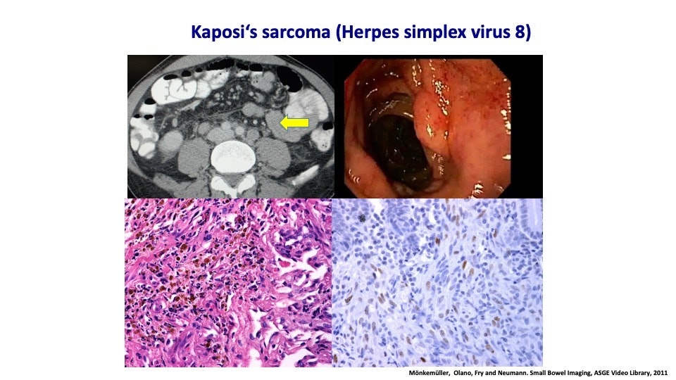 Kaposi’s Sarcoma