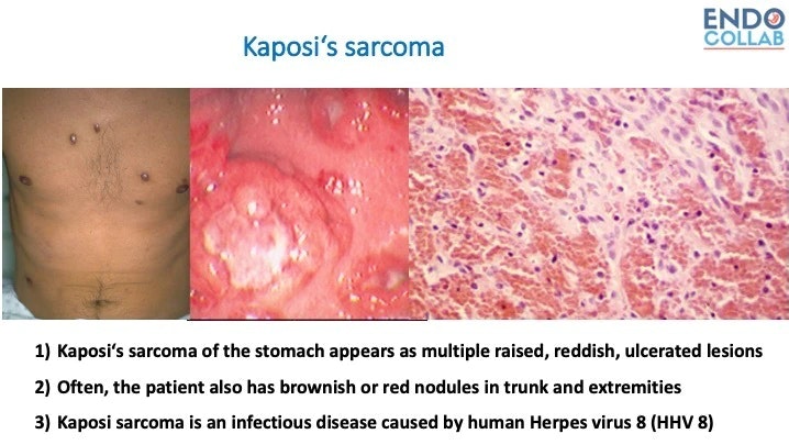 Kaposi’s Sarcoma Of The Stomach