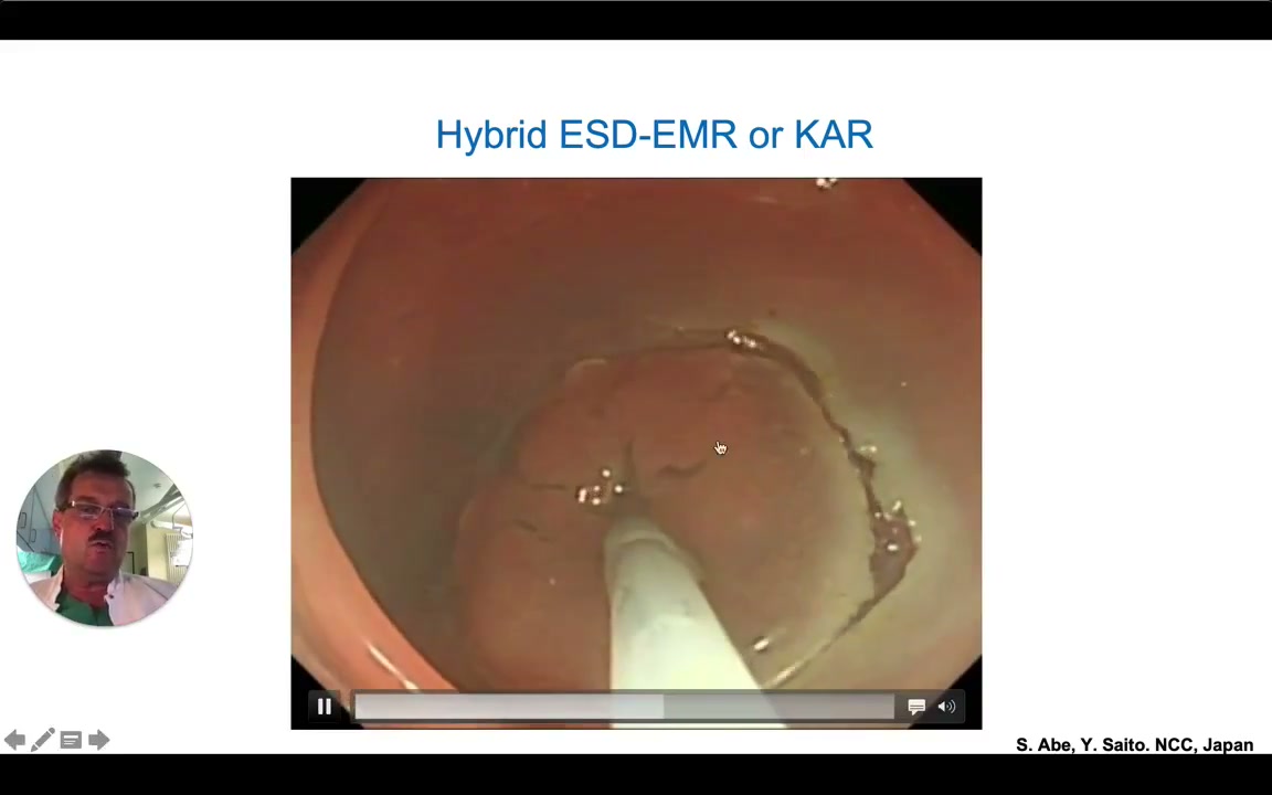 Kar Hybrid Esd-Emr: Circumferential Tip-Of-Snare Incision 2 Tip-Of-Snare Circumferential Mucosal Incision With Free Lateral Margin