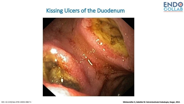 Kissing Ulcers Of The Duodenum