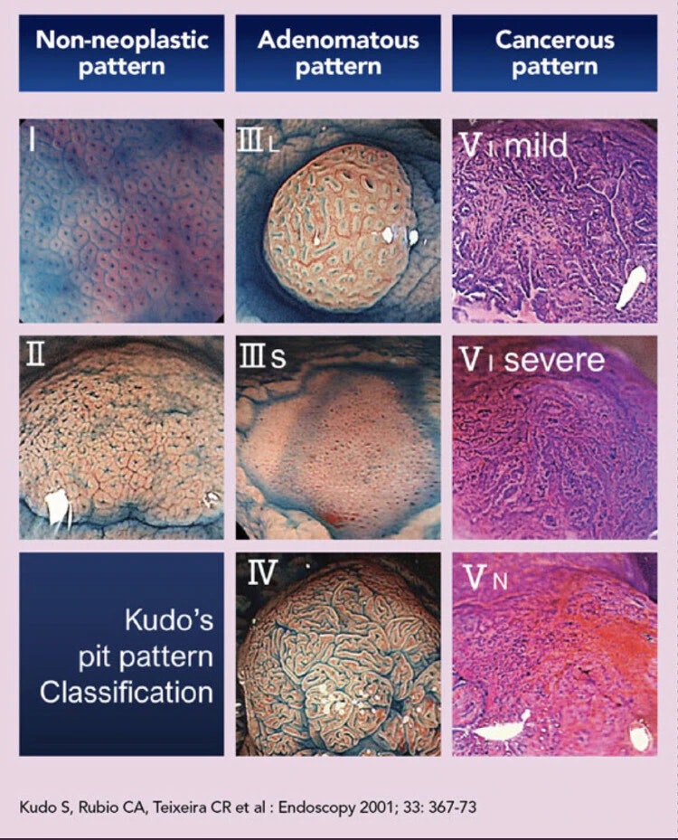 Kudo Pit Pattern Classification 19 Kudo Pit Pattern Classification
