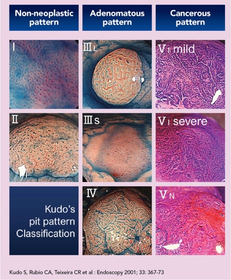 Kudo Pit Pattern Classification