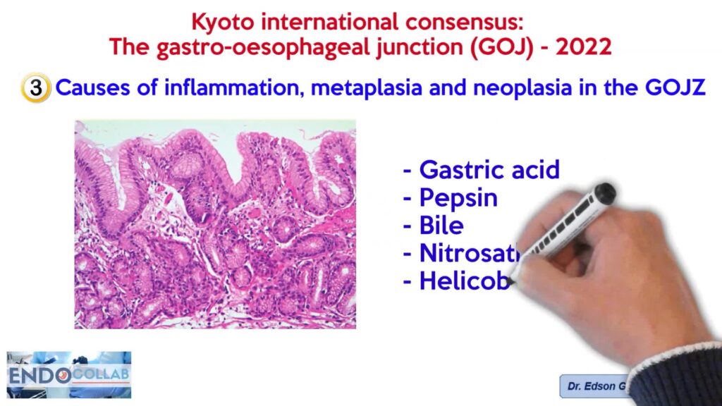 Kyoto International Consensus; The Gastro-Oesophageal Junction (Goj) - 2022 1 Kyoto International Consensus; The Gastro-Oesophageal Junction (Goj) – 2022