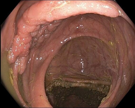 Laterally Spreading Tumors (Lst) 17 Laterally Spreading Tumors (Lst)