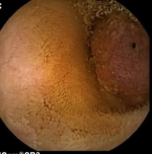 Lesion Found In A 40-Year Old Patient With History Of Abdominal Pain 7 Lesion Found In A 40-Year Old Patient With History Of Abdominal Pain