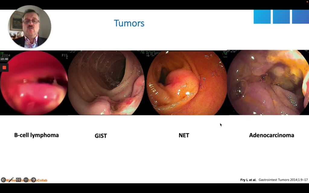 Lesiones Ulcerativas del Intestino Delgado