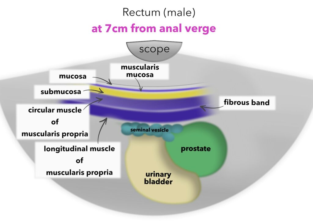Linear Eus For Examination Of The Rectum &Amp; Anal Canal 11 Linear Eus For Examination Of The Rectum &Amp; Anal Canal