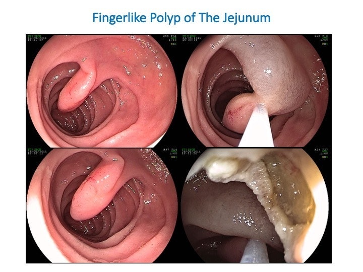 Lipoma Of The Small Bowel 5 Lipoma Of The Small Bowel