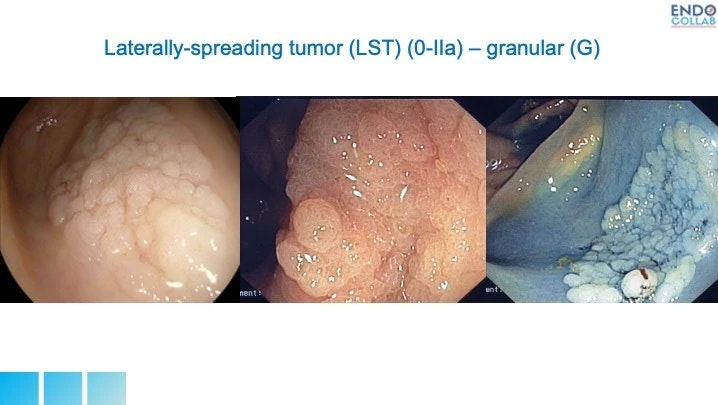 Lst – G
