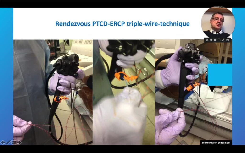 Malignant Bile Duct Strictures – Draining Strategies