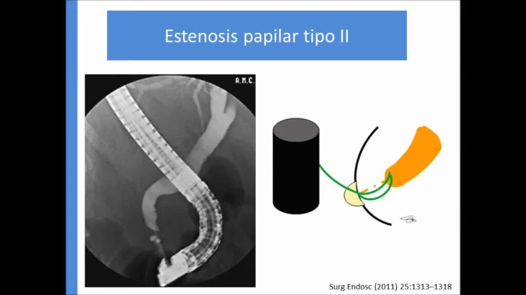 Manejo De Litiasis Compleja Impactada Por Dr Martin Guidi
