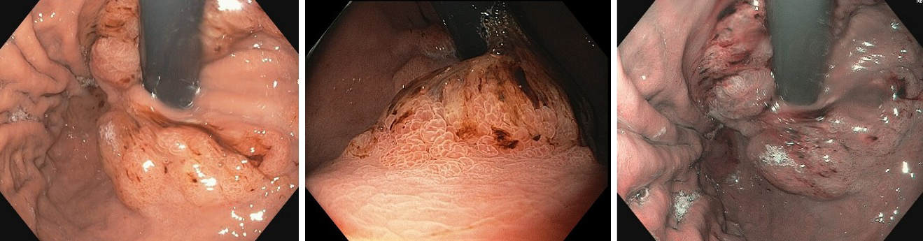 Gi Endoscopy Community &Amp; Education - Endocollab