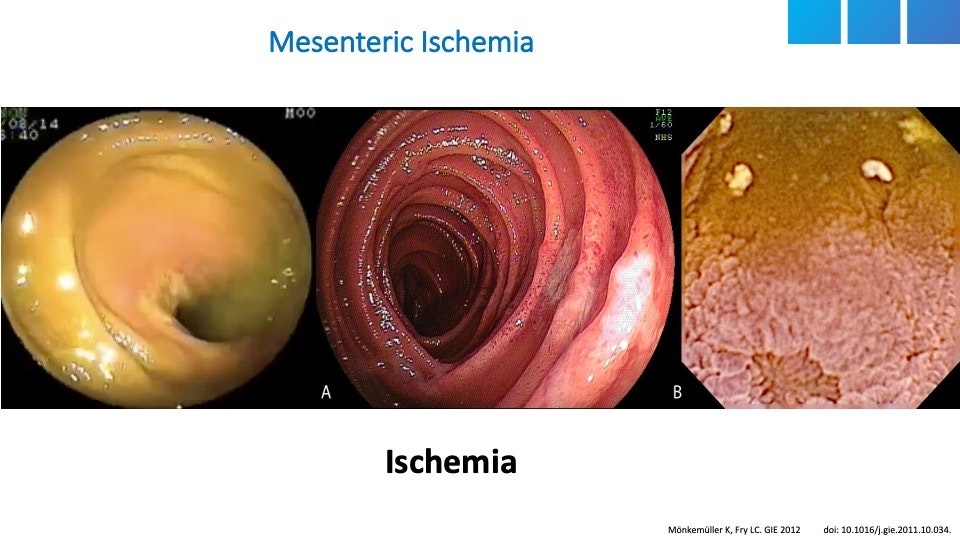 Mesenteric Ischemia