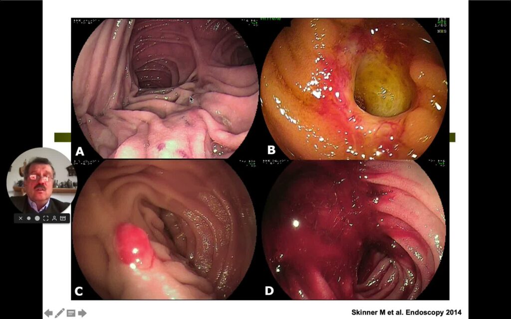 Mistakes in the Management of Small Bowel Bleeding: and How to Avoid Them