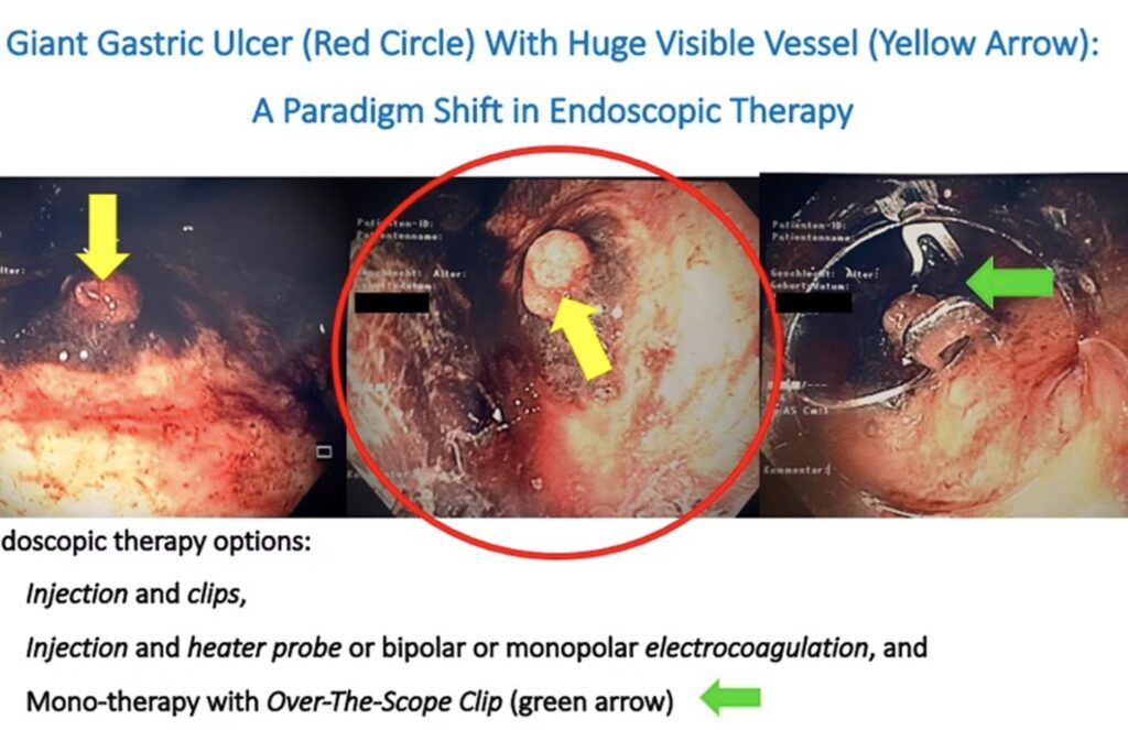 Mono-Endoscopic Therapy For Peptic Ulcer Bleeding 3 Mono-Endoscopic Therapy For Peptic Ulcer Bleeding