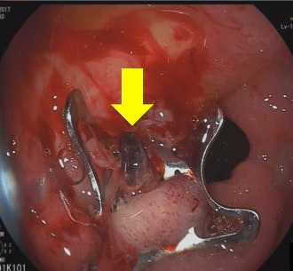 Monotherapy With Otsc For Torrential Ulcer Bleeding