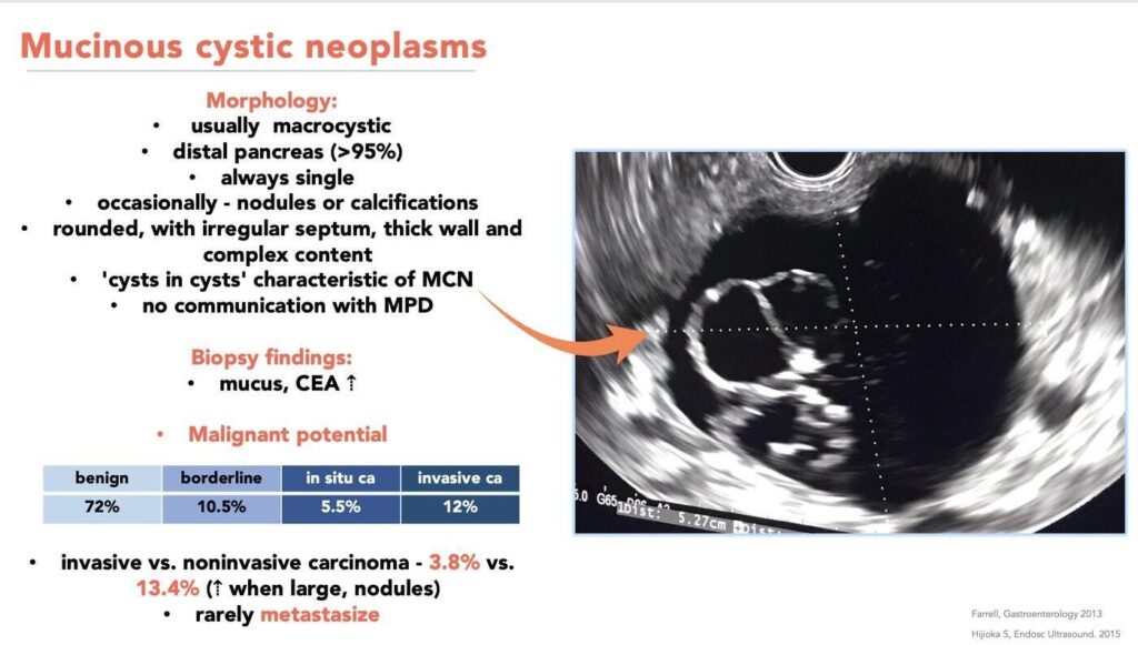 Mucinous Cystic Neoplasia - Quick Overview 9 Mucinous Cystic Neoplasia – Quick Overview
