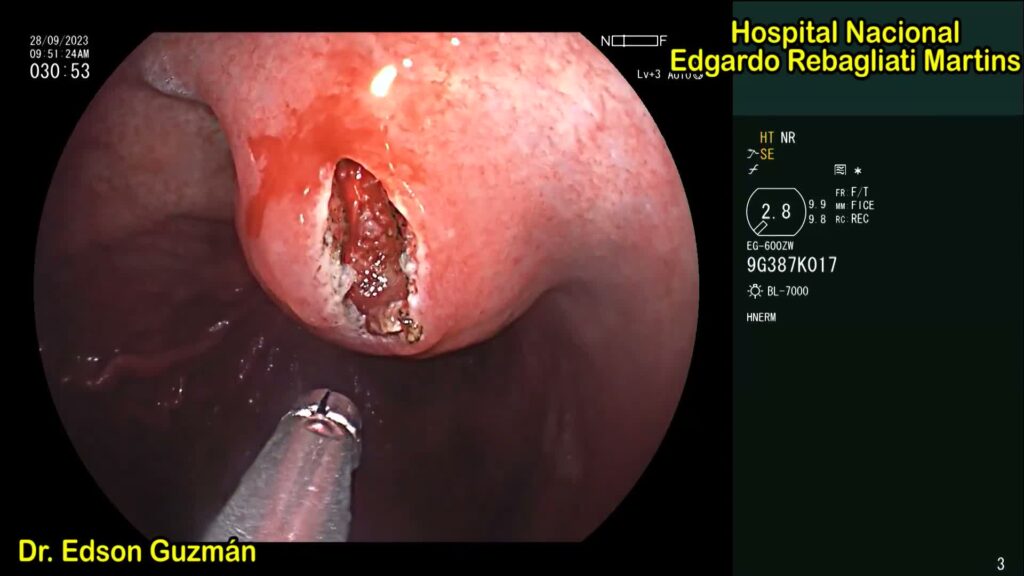 Mucosal Incision-Assisted Biopsy (Miab)For Gastric Subepithelial Lesions By Edson Guzman Calderon