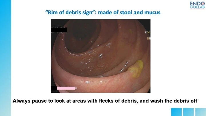 Mucous And Debris Help Find Flat, Serrated Lesions