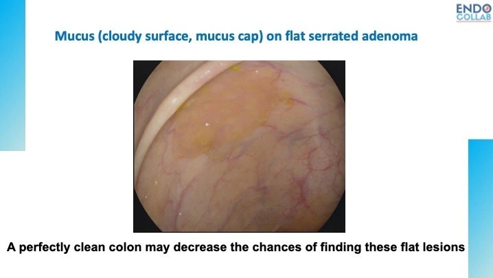 Mucous Cap On Serrated Adenoma