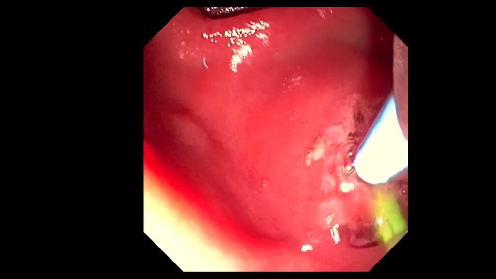 Needle-Knife Fistulotomy (NKF)