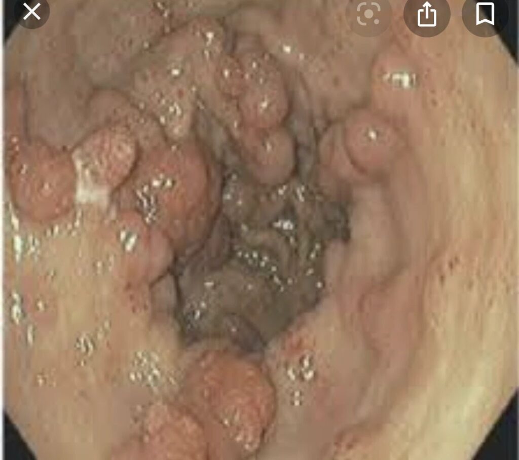 Nodular Gave In Cirrhotic Patient With Anemia