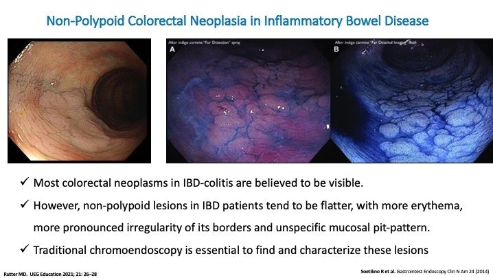 Non-Polypoid Colorectal Neoplasia In Inflammatory Bowel Disease 15 Non-Polypoid Colorectal Neoplasia In Inflammatory Bowel Disease