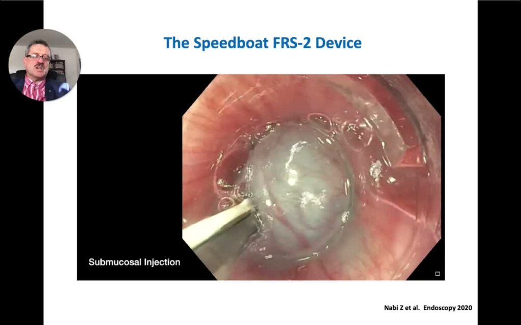 Novel Endoscopic Resection Tool: The Speedboat Device