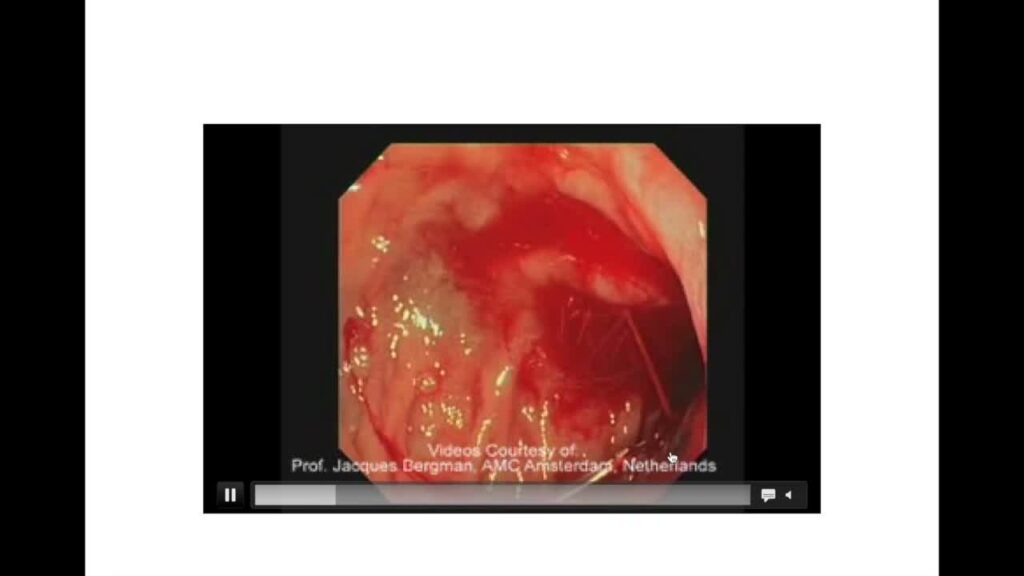 Novel Tools And Methods For Upper Gi Bleeding