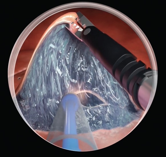 Novel Traction Techniques For Advanced Endoscopic Resection