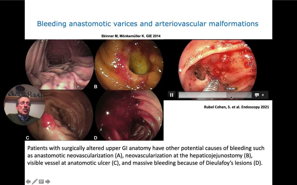 Nuevos Perspectivas En Endoscopía De Intestino Delgado 10 Nuevos Perspectivas En Endoscopía De Intestino Delgado