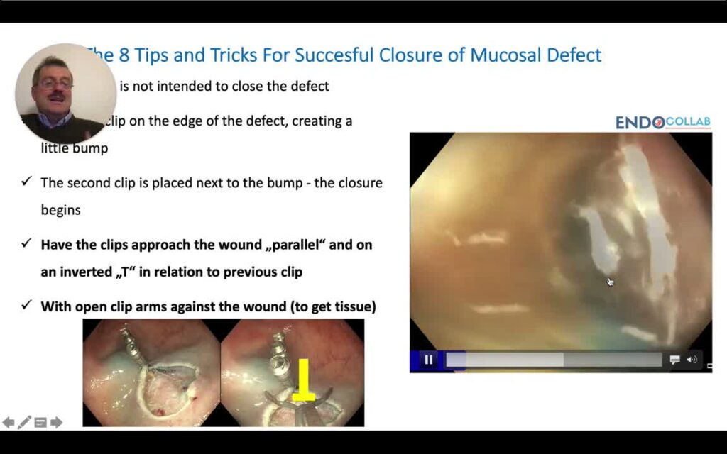 Ocho Consejos Y Tips Para Cierre De Defectos Mucosos Grandes Usando Clips