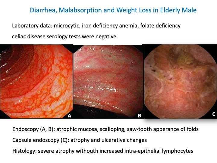 Olmesartan Enteropathy