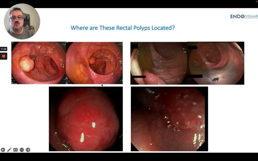 Orientación Espacial Durante Examen Endoscopio De Recto Y Rectosigmoides 8 Orientación Espacial Durante Examen Endoscopio De Recto Y Rectosigmoides