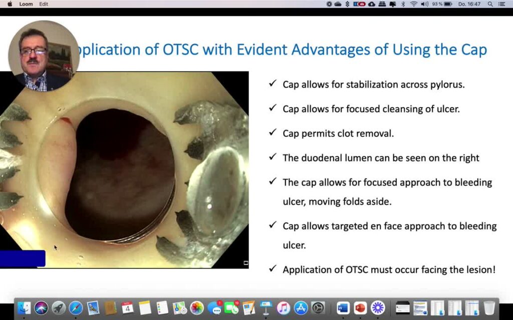 Otsc For Duodenal Ulcer Bleeding