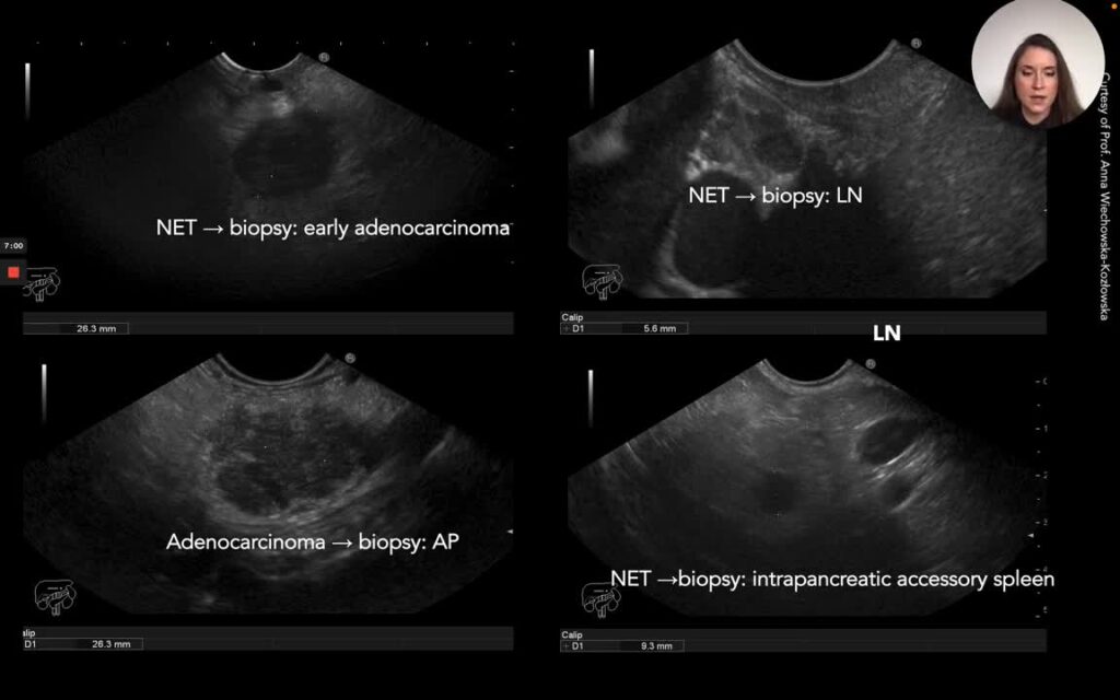 Pancreatic Incidentalomas 11 Pancreatic Incidentalomas