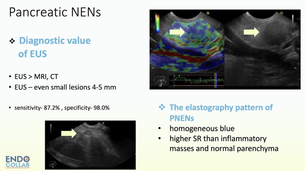 Pancreatic Nens In Eus 7 Pancreatic Nens In Eus