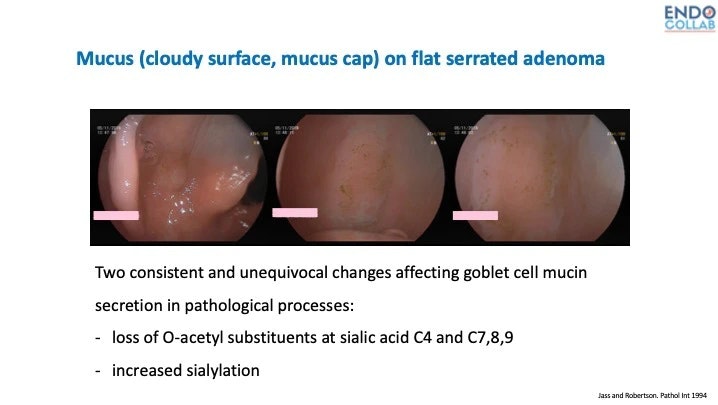 Pathophysiology Of The Mucous Cap On Serrated Lesions