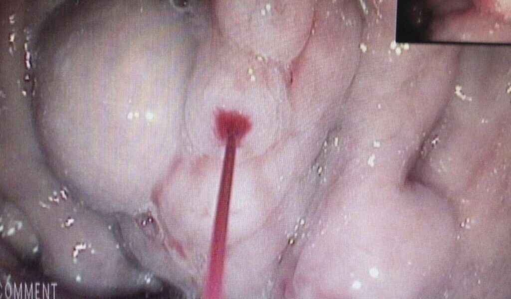 Patient With Haematemesis… And No Cyanoacrilate Or Sengstaken-Blakemore Balloon By Leandro Steinberg