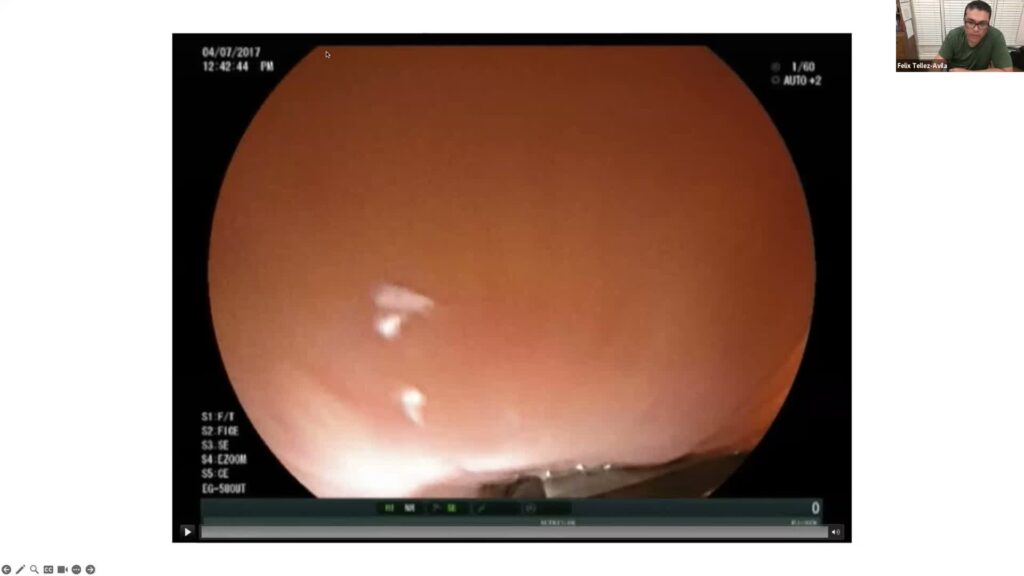 PFC drainage ONLY with EUS view