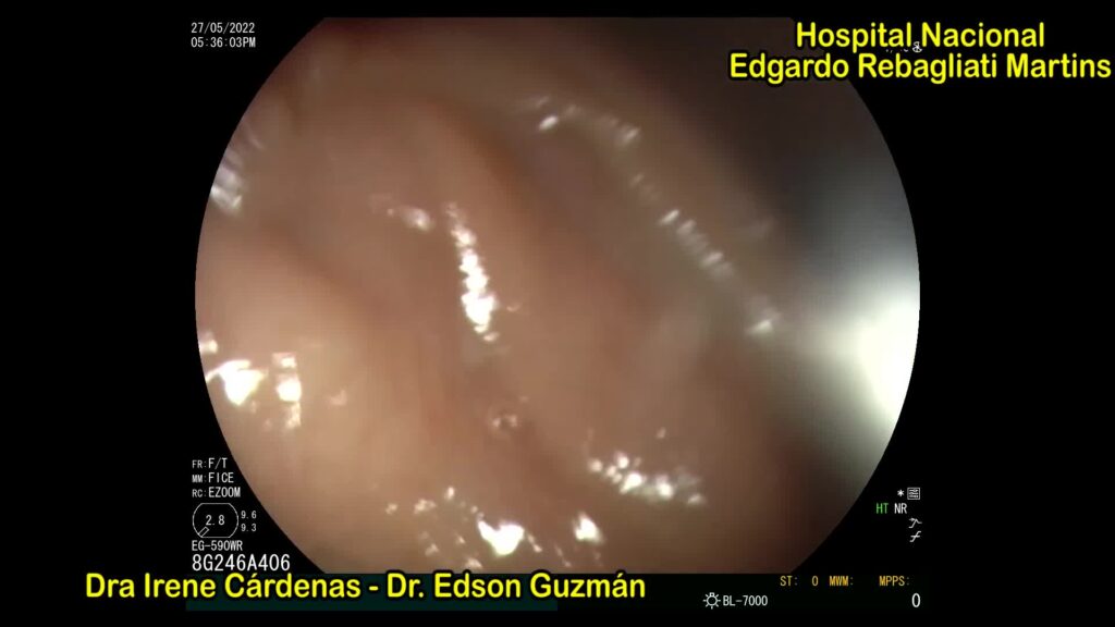Placement Of Fcsems In A Patient With Postsurgical Esophagojejunal Stricture And A Fistula By Edson Guzman Calderon
